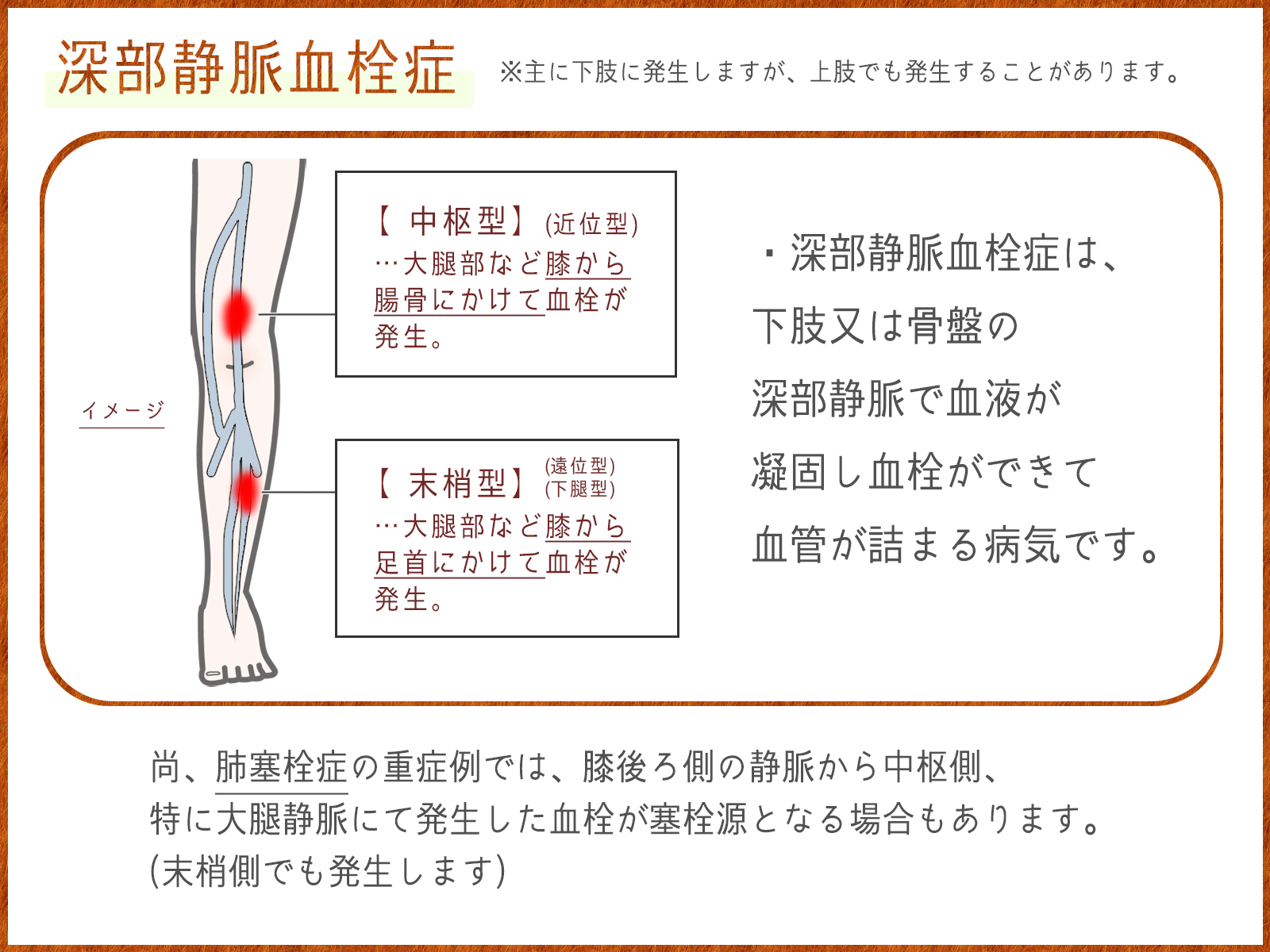 静脈血栓症の症状